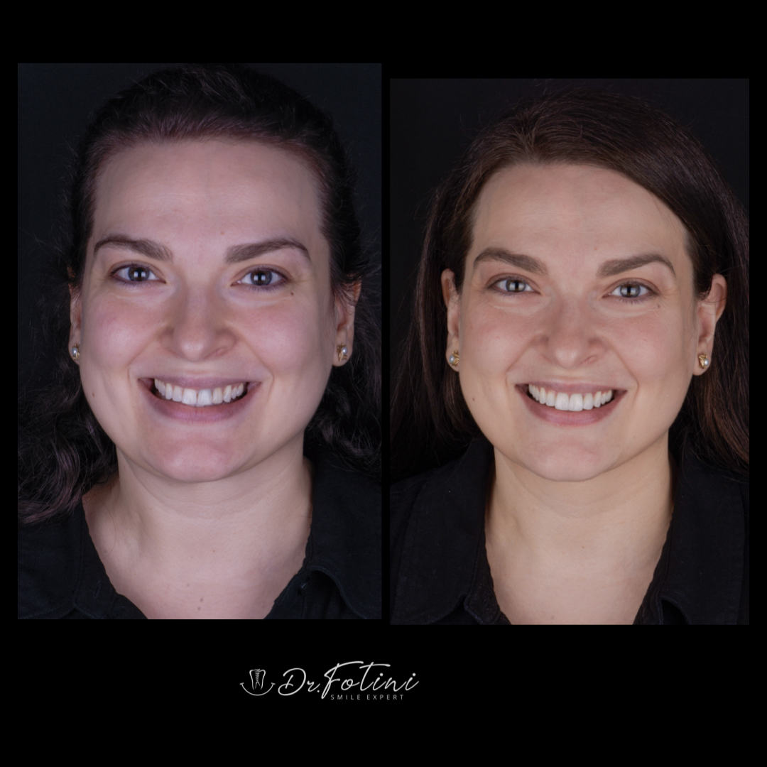 Cosmetic Dentistry Before and After by Dr. Fotini in Tysons Corner, VA