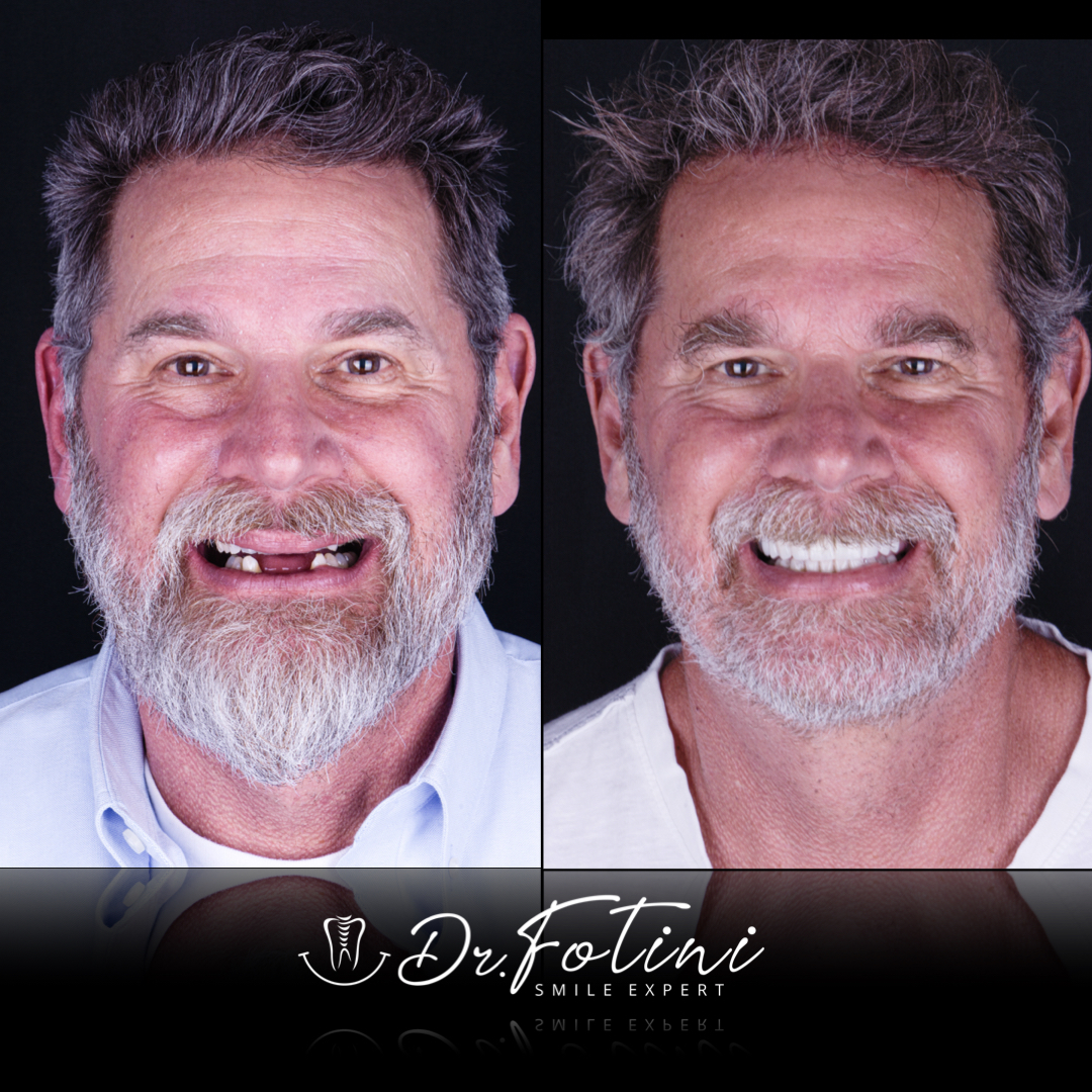 Dental Implants Before and After by Dr. Fotini in Tysons Corner, VA