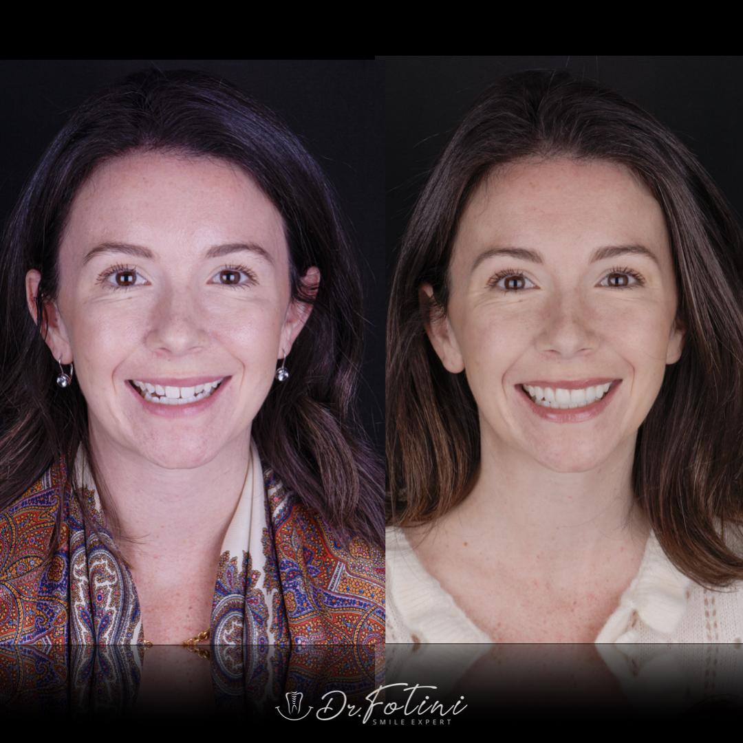 Dental Veneers Before and After by Dr. Fotini in Tysons Corner, VA