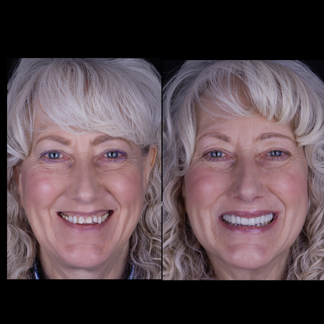 Full Mouth Reconstruction Before and After by Dr. Fotini in Tysons Corner, VA