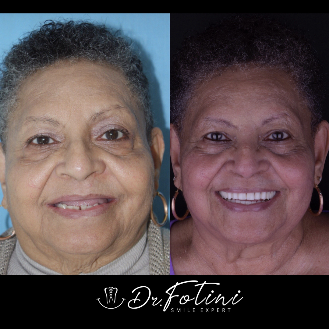 Implant Overdenture Before and After by Dr. Fotini in Tysons Corner, VA