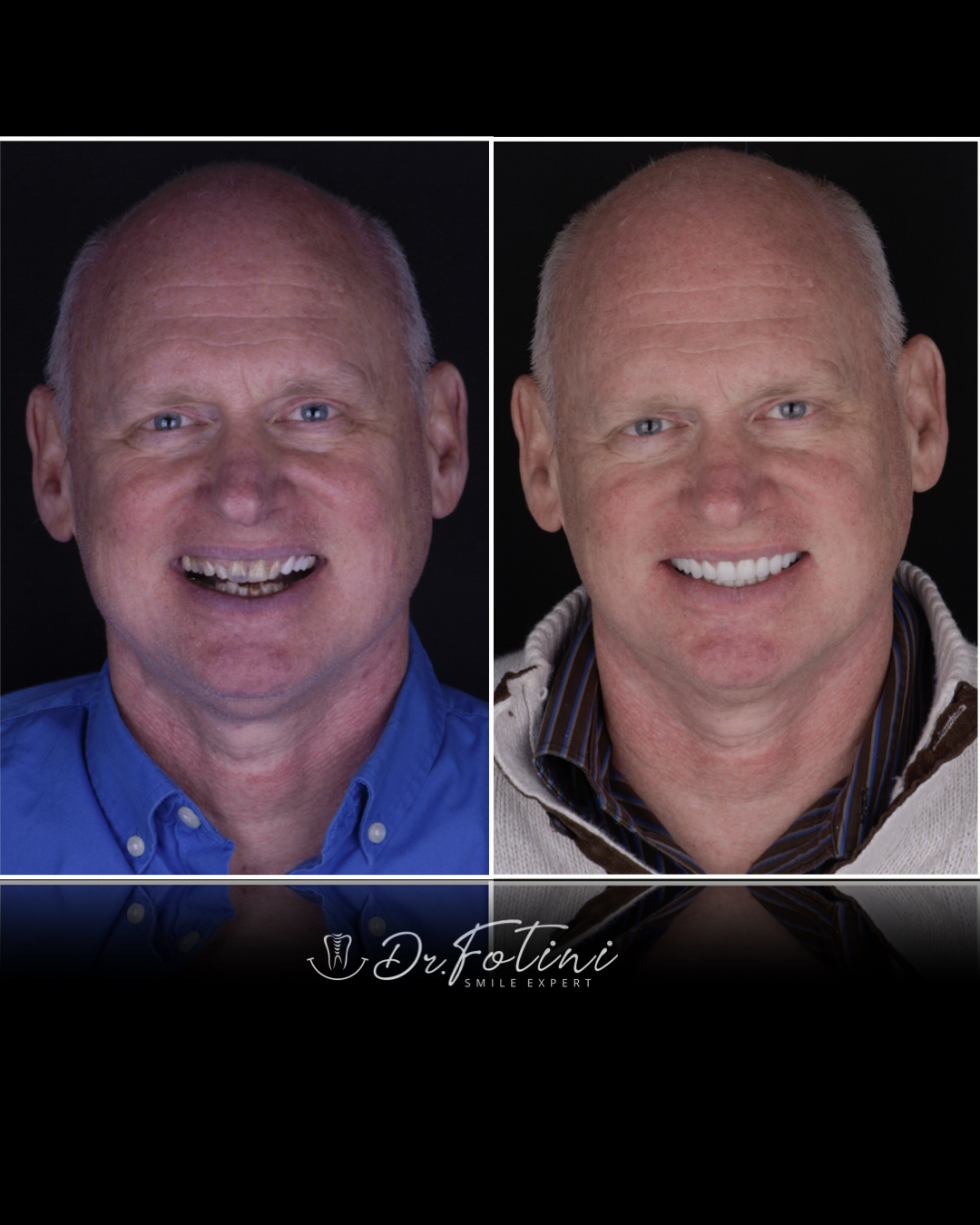 Smile Makeover Before and After by Dr. Fotini in Tysons Corner, VA