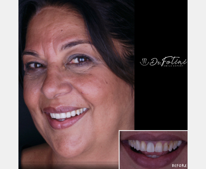 Smile Transformation Before and After by Dr. Fotini in Tysons Corner, VA