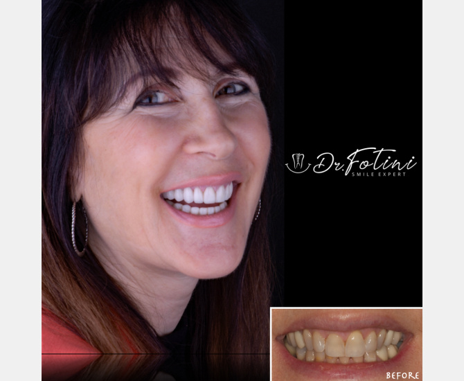 Smile Transformation Before and After by Dr. Fotini in Tysons Corner, VA