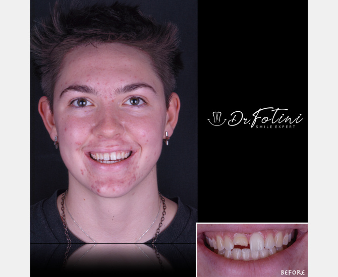 Smile Transformation Before and After by Dr. Fotini in Tysons Corner, VA