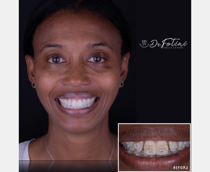 Smile Transformation Before and After by Dr. Fotini in Tysons Corner, VA