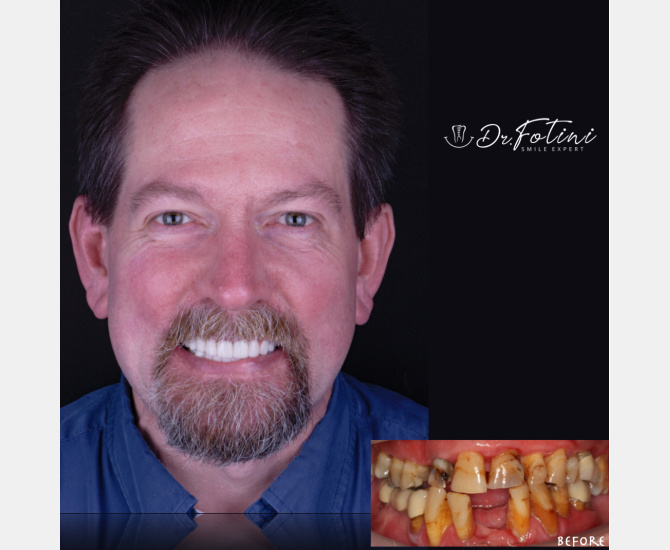 Smile Transformation Before and After by Dr. Fotini in Tysons Corner, VA