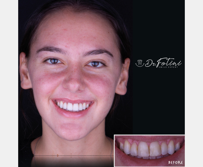 Smile Transformation Before and After by Dr. Fotini in Tysons Corner, VA