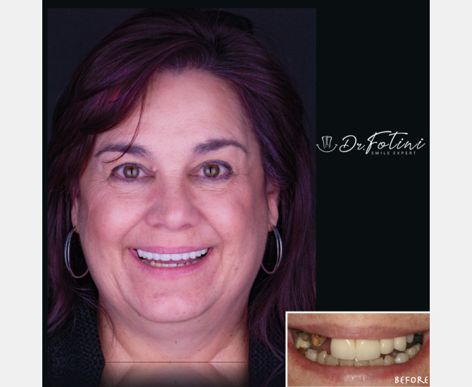 Smile Transformation Before and After by Dr. Fotini in Tysons Corner, VA
