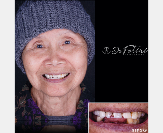 Smile Transformation Before and After by Dr. Fotini in Tysons Corner, VA