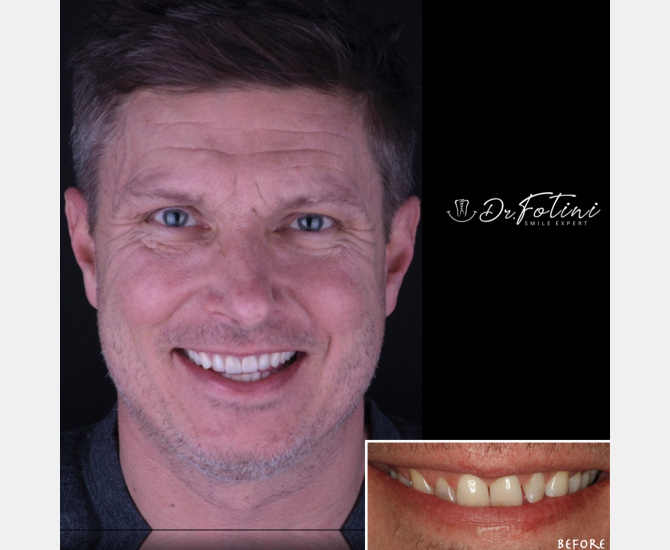 Smile Transformation Before and After by Dr. Fotini in Tysons Corner, VA