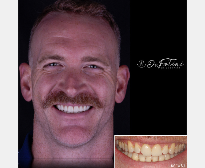 Smile Transformation Before and After by Dr. Fotini in Tysons Corner, VA