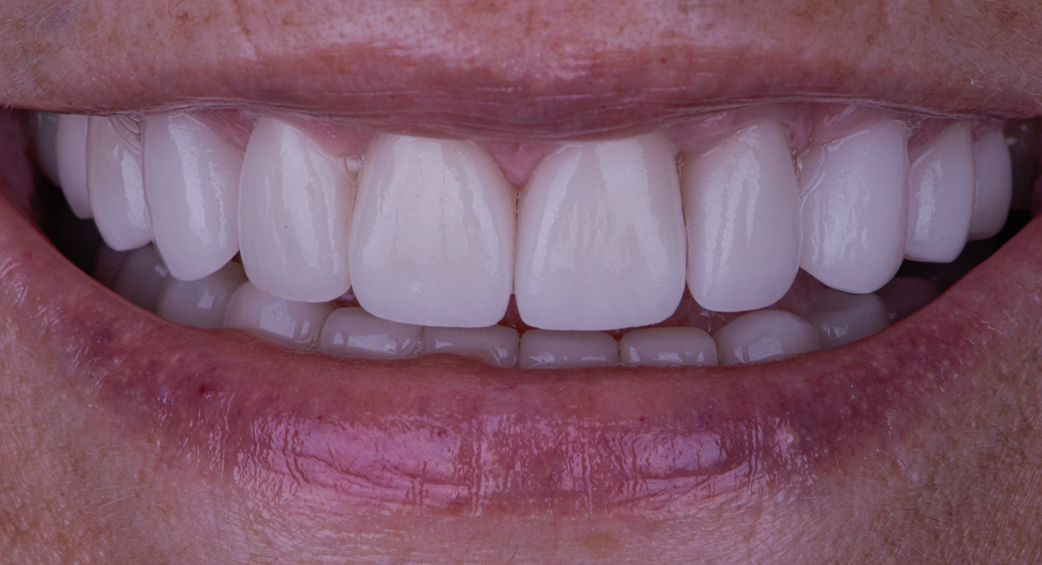 Full Mouth Reconstruction On Teeth - After