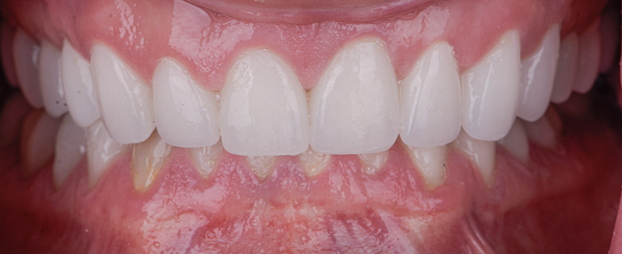 Full Mouth Reconstruction With Porcelain Crowns - After