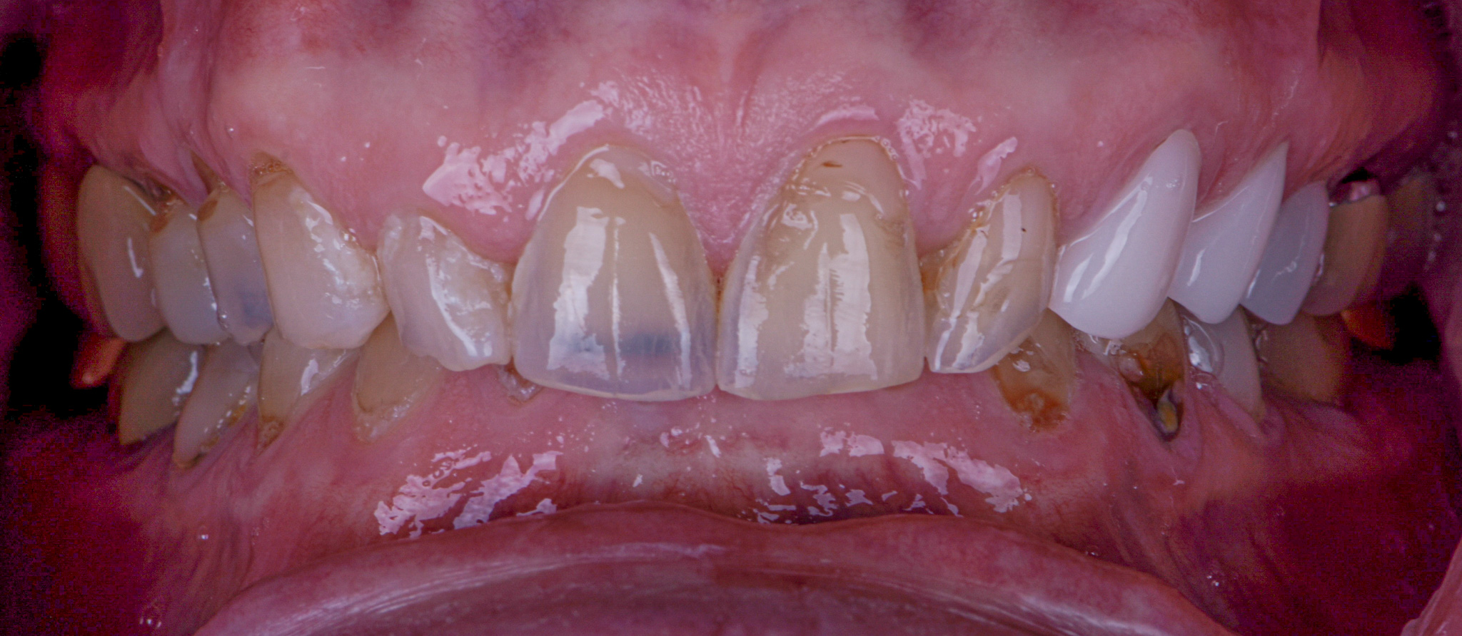Full Mouth Reconstruction With Porcelain Crowns - Before