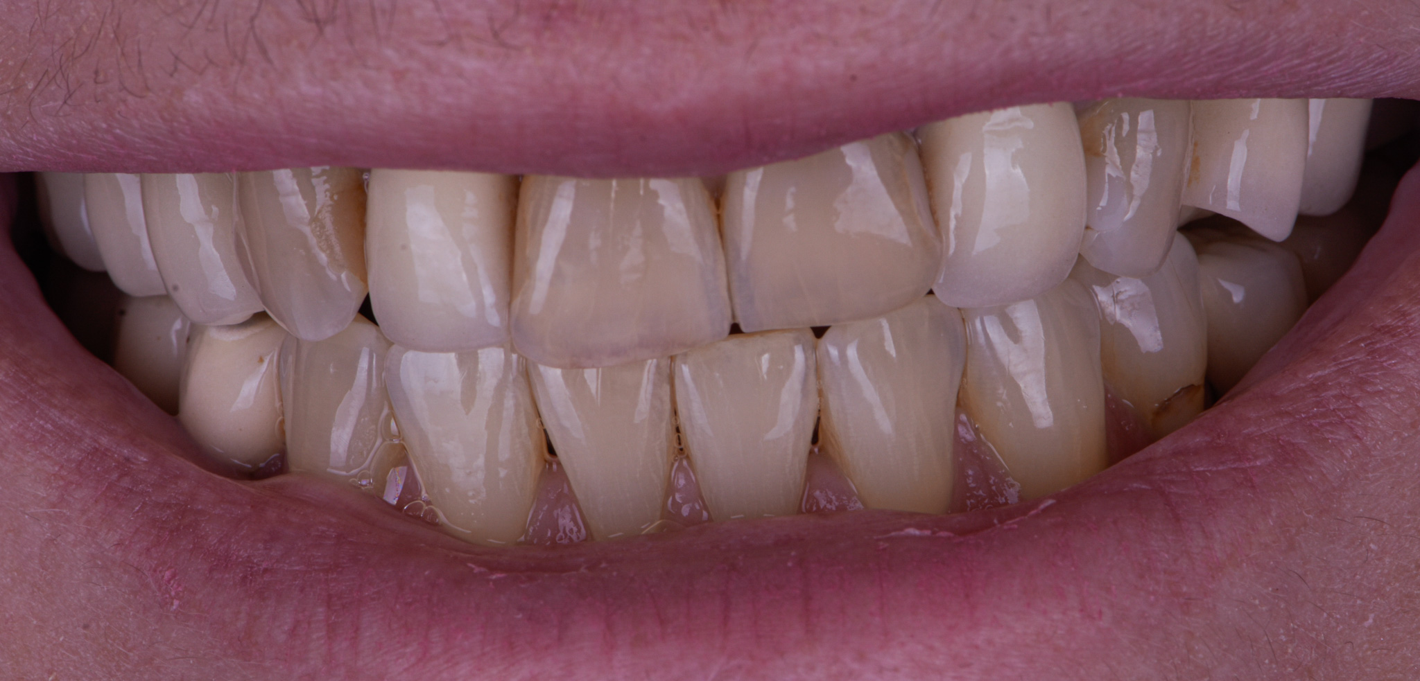 Full Mouth Rehabilitation On Teeth And Dental Implants - After