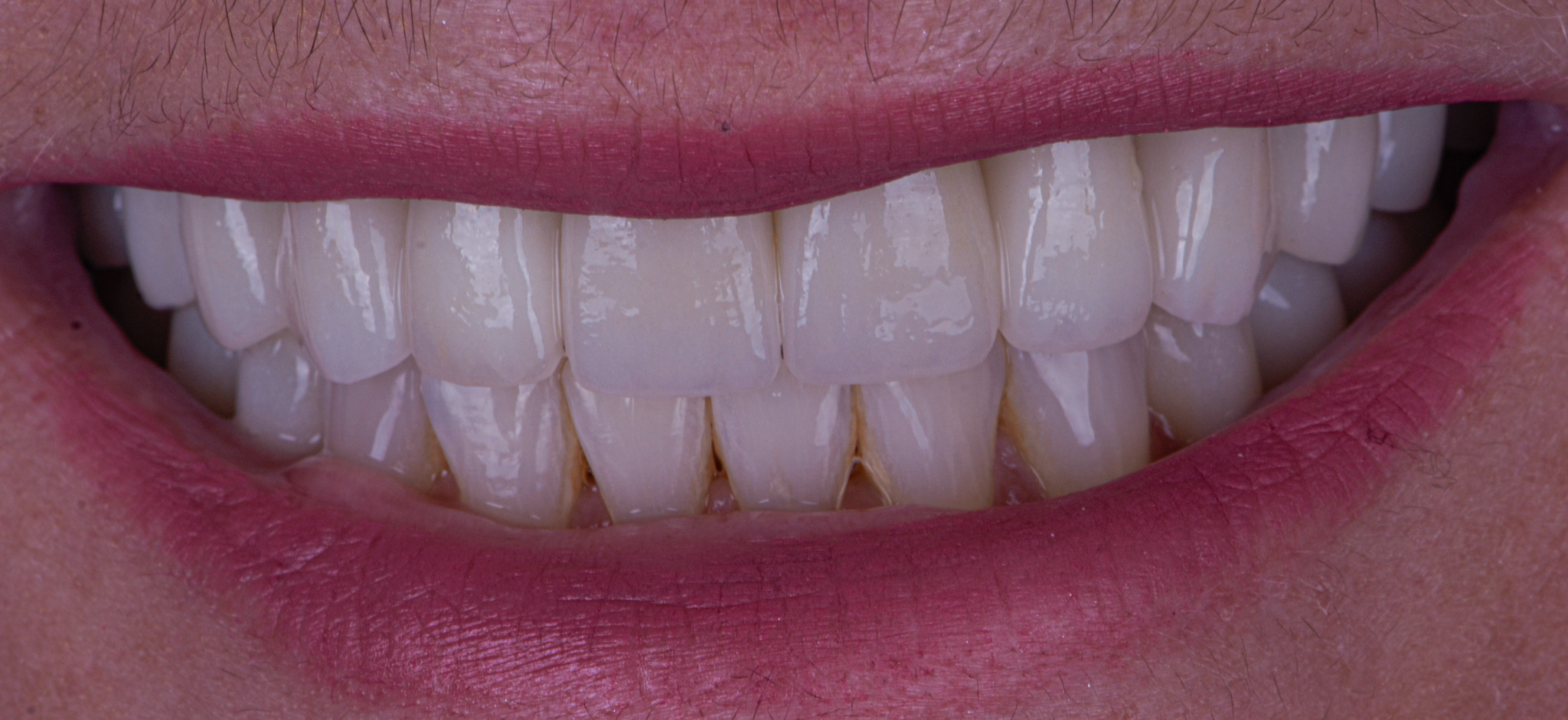 Full Mouth Rehabilitation On Teeth And Dental Implants - Before