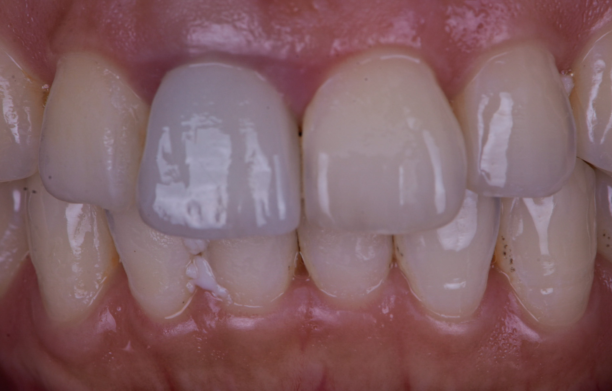 Implant Crown To Replace Central Incisor - Before