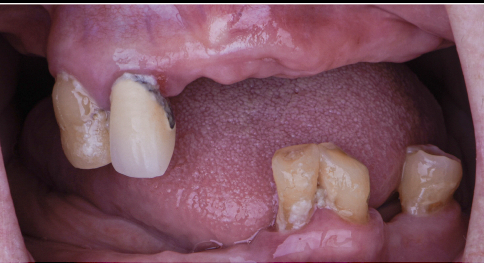 Implant Supported Overdentures Removable - Before