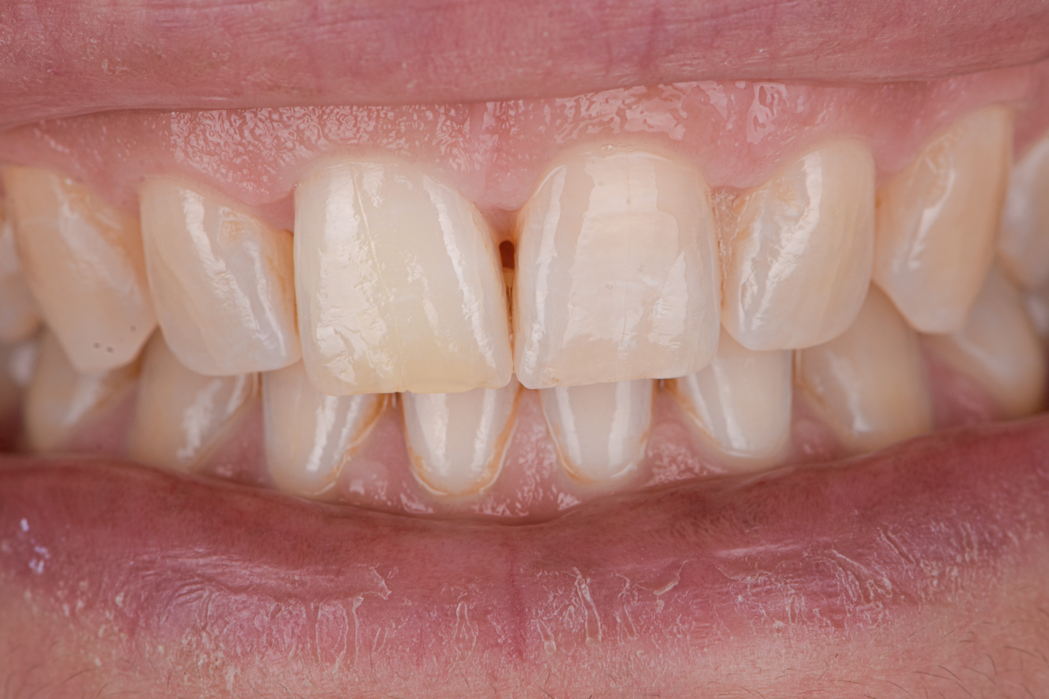 Internal Bleaching For Discolored Teeth - After