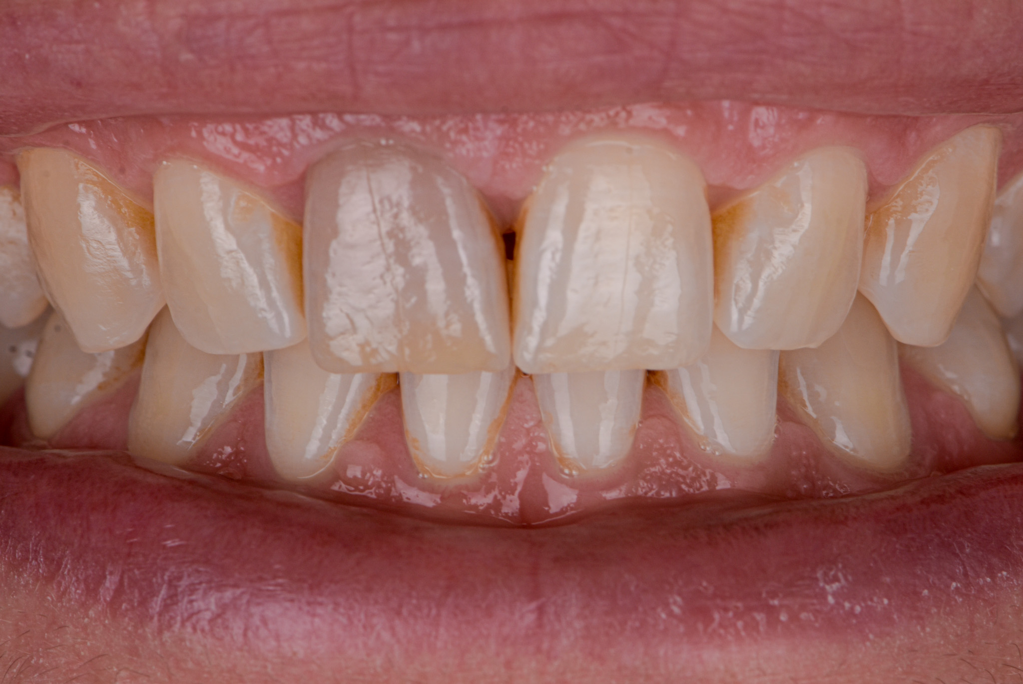 Internal Bleaching For Discolored Teeth - Before