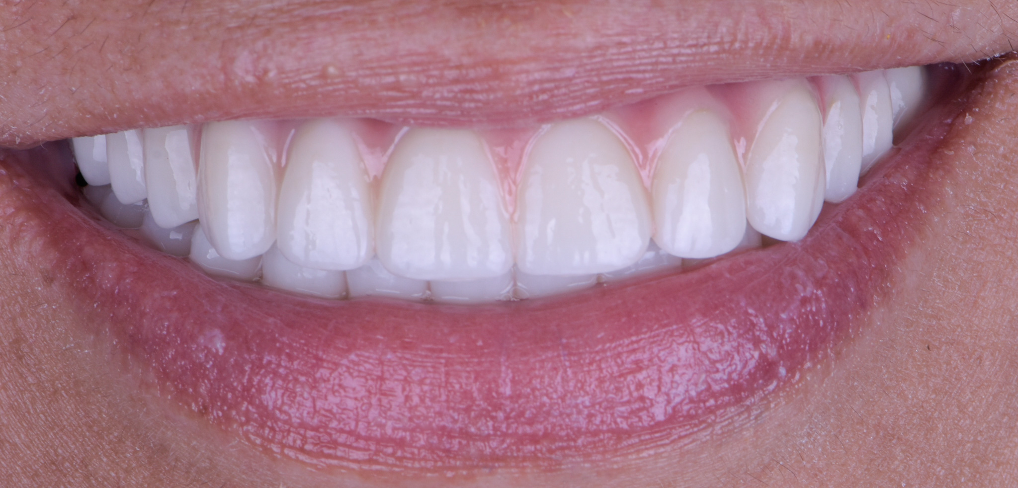 Permanent Implant Supported Porcelain Bridge - After