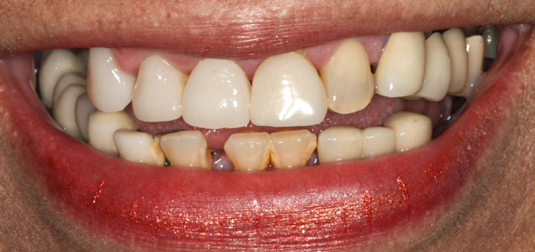 Permanent Implant Supported Porcelain Bridge - Before