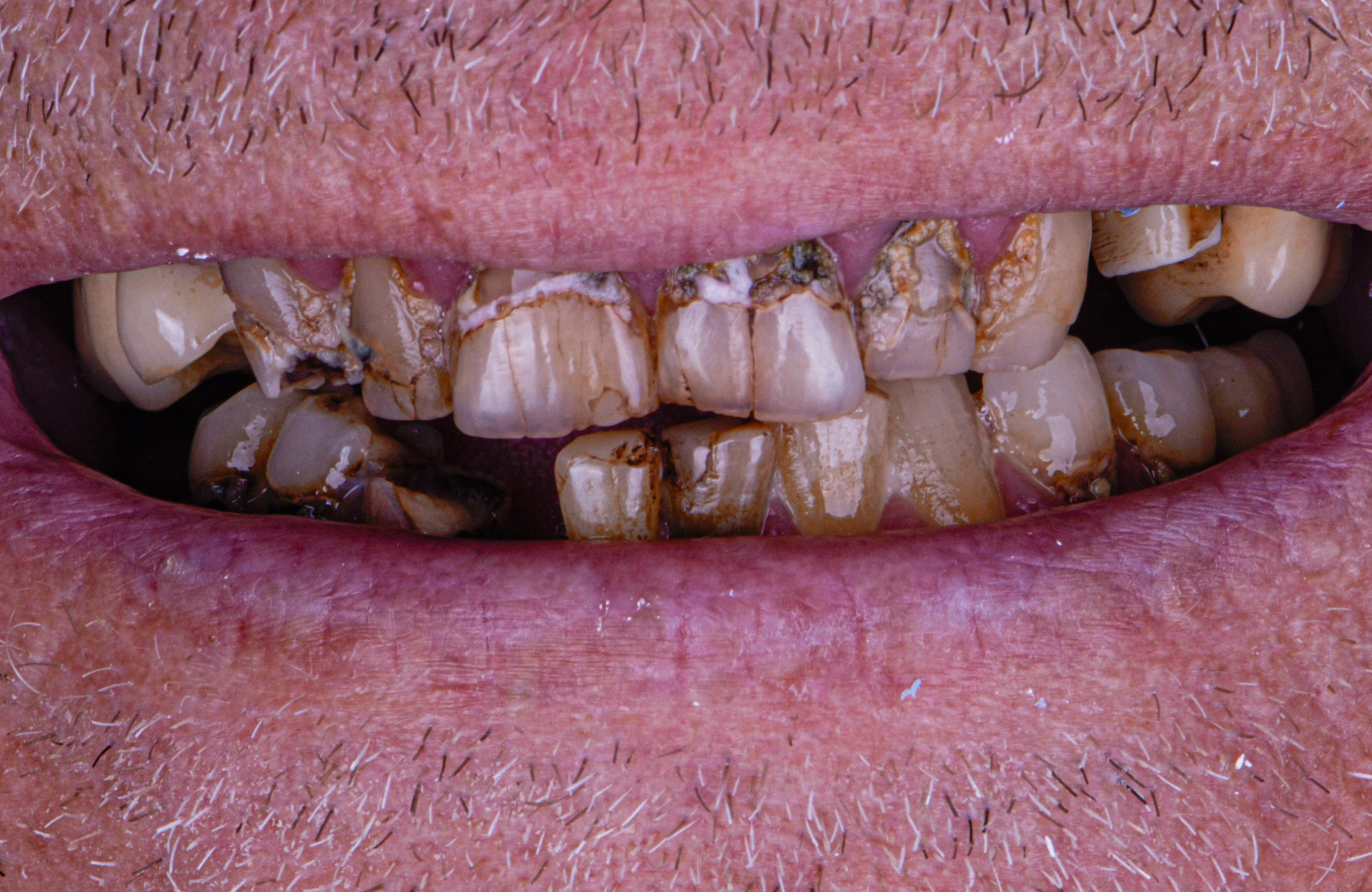 Permanent Implant Supported Porcelain Bridges - Before
