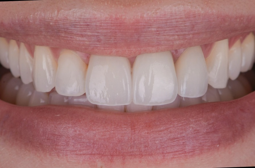 Porcelain Crowns Veneers And Teeth Whitening - After