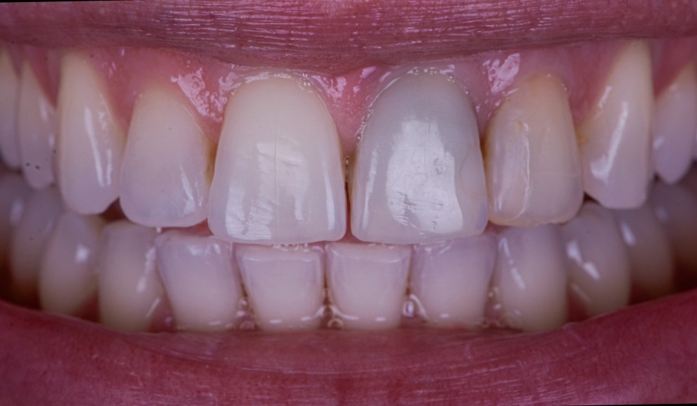 Porcelain Crowns Veneers And Teeth Whitening - Before
