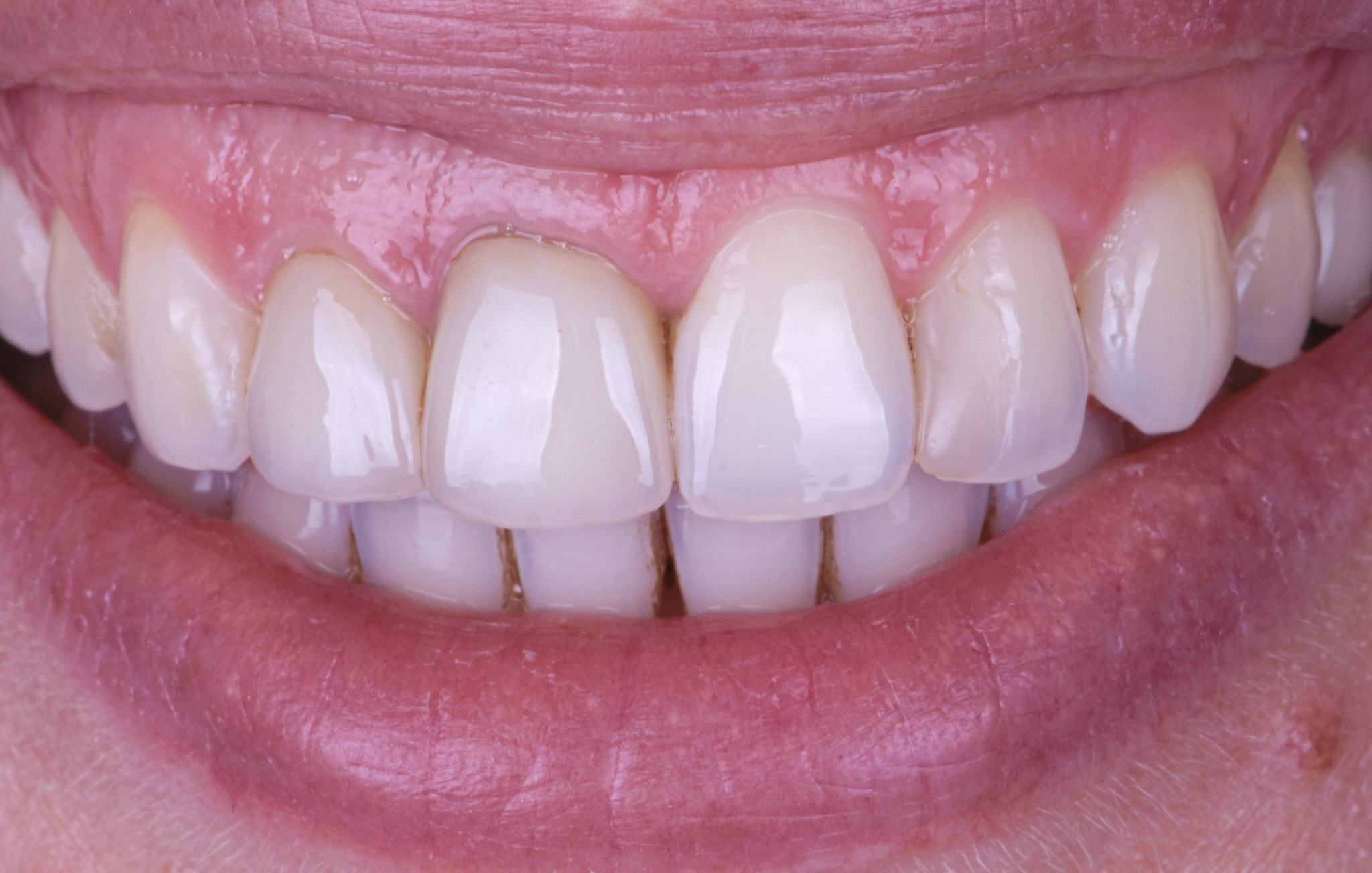 Porcelain Crowns Veneers With Gum Recountouring - Before