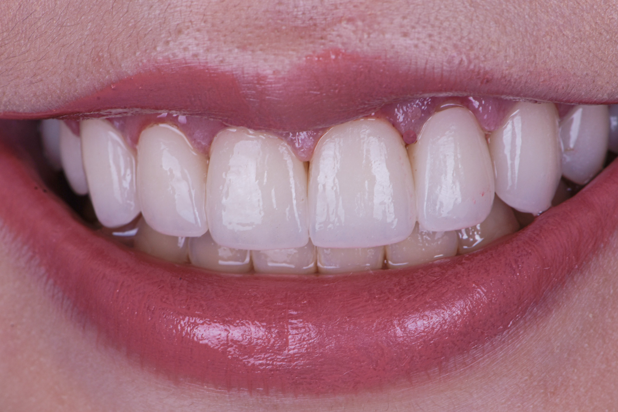 Porcelain Veneers And Laser Gingiva Recontouring To Correct Discoloration And Gummy Smile - After
