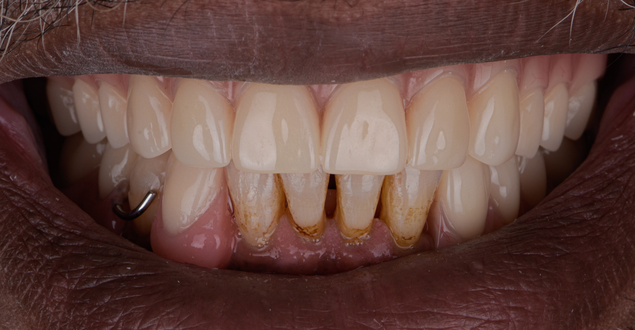 Removable Complete And Partial Dentures - After