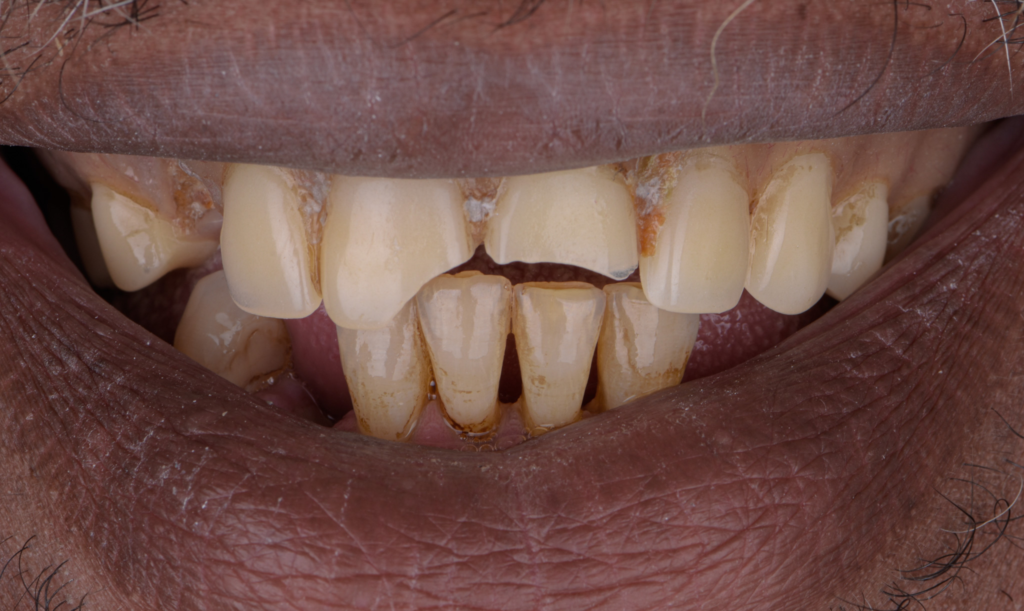 Removable Complete And Partial Dentures - Before
