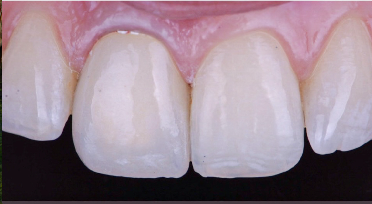 Single Central Incisor Porcelain Crown With Custom Shade - After