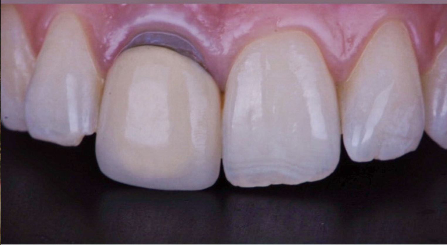 Single Central Incisor Porcelain Crown With Custom Shade - Before