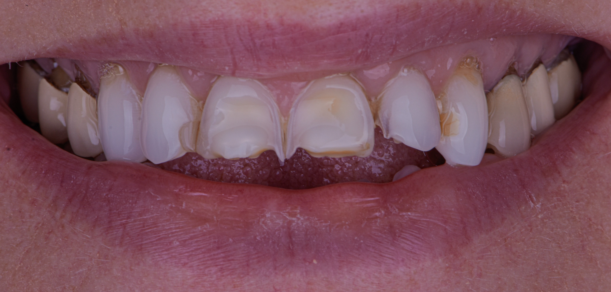 Smile Makeover With Porcelain Crowns - Before