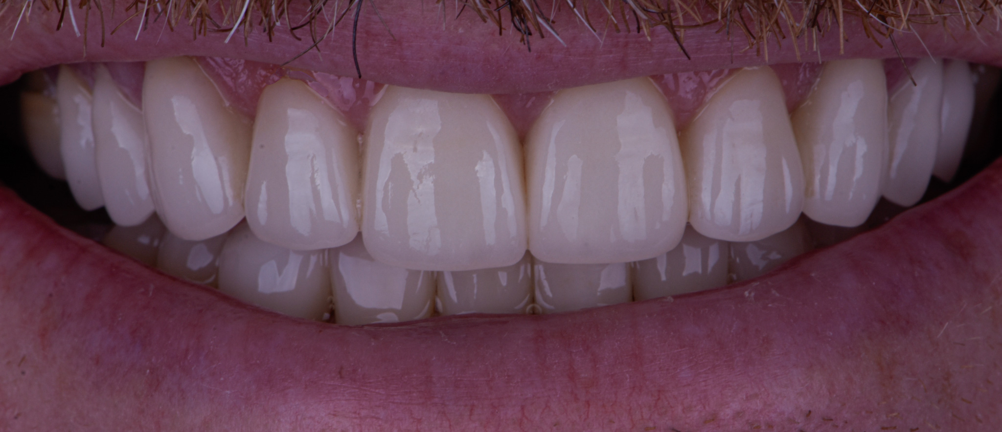 Smile Makeover With Porcelain Veneers 1 - After