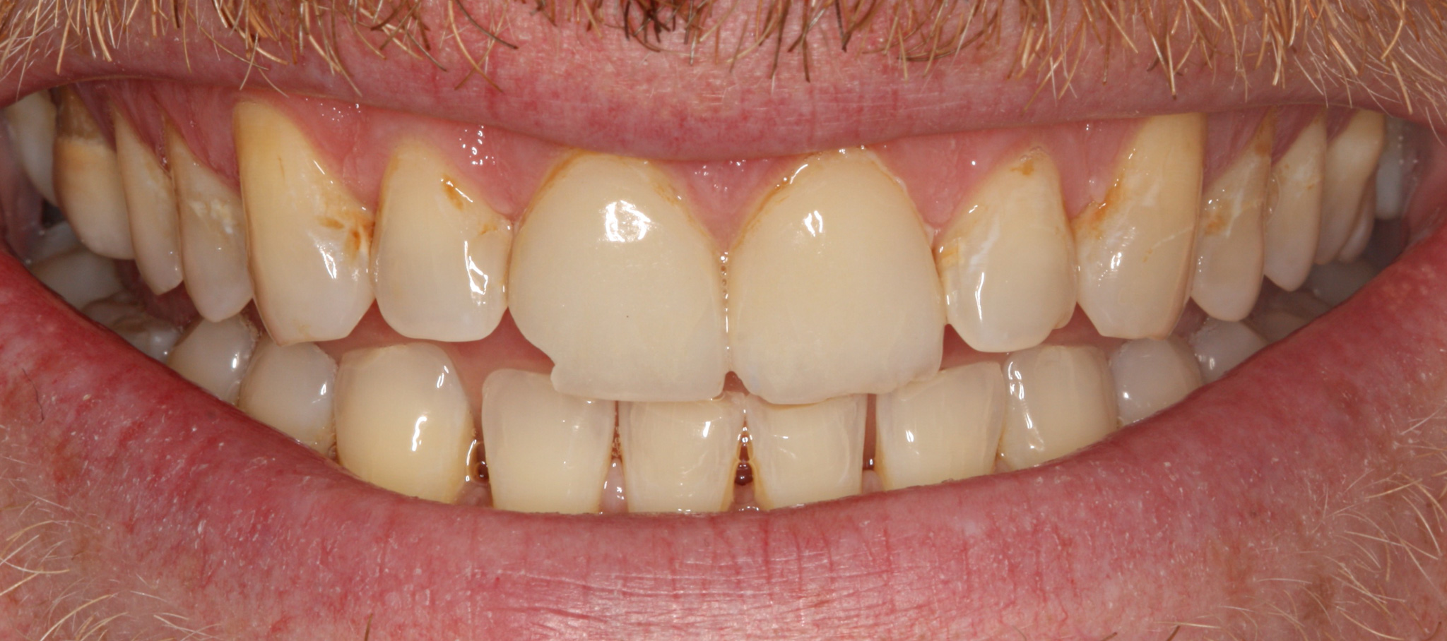 Smile Makeover With Porcelain Veneers 1 - Before
