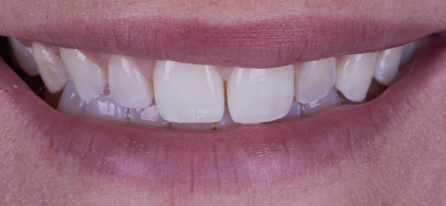 Smile Makeover With Porcelain Veneers - Before