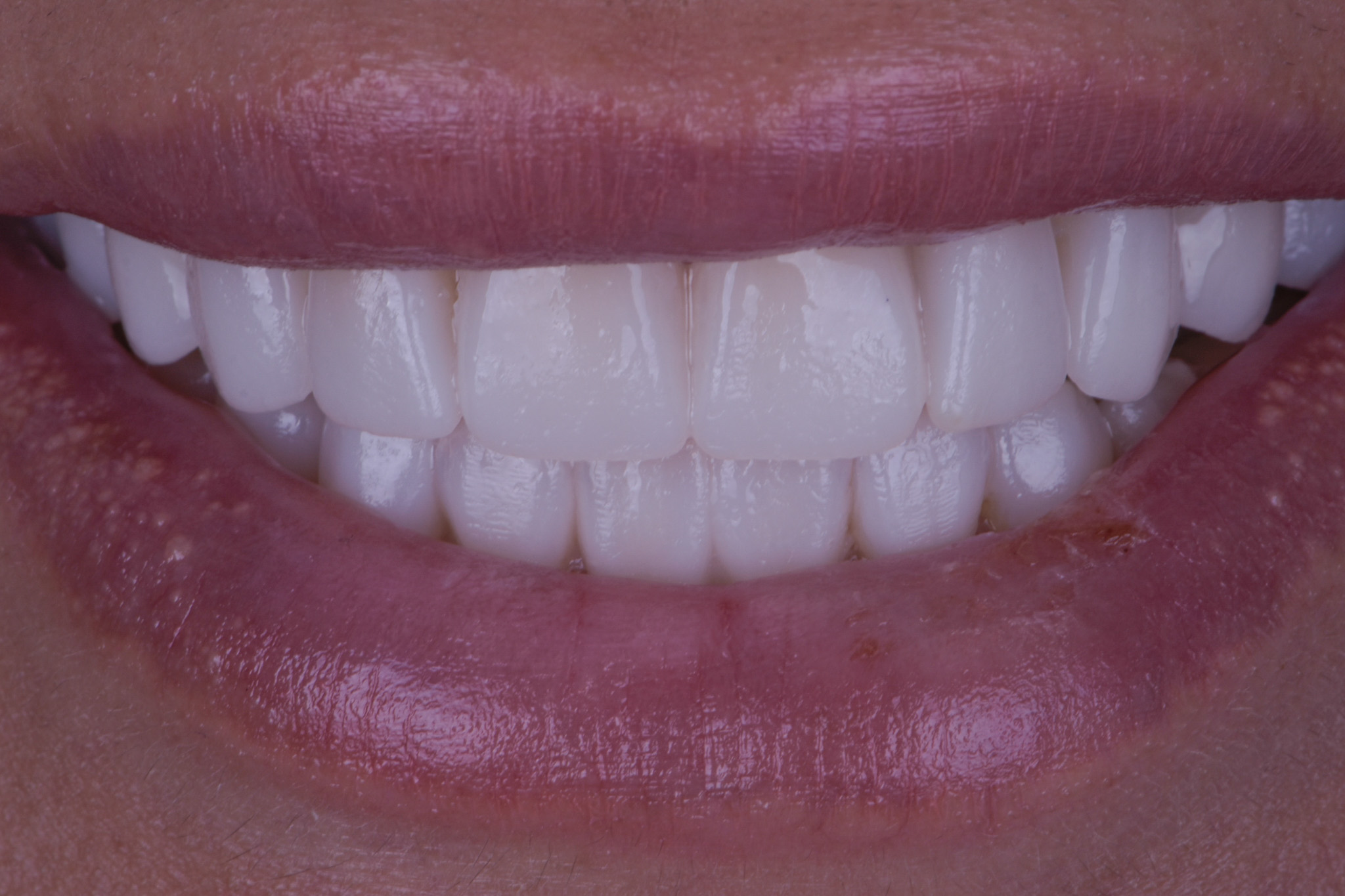 Smile Mock Up Based On Digital Smile Design - After