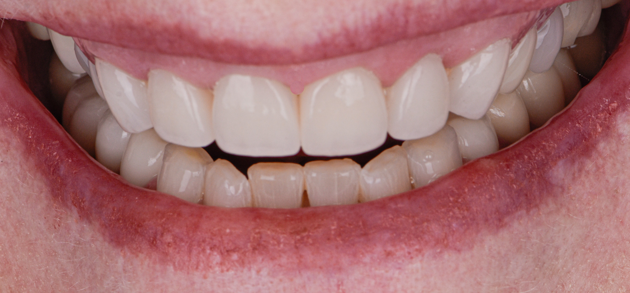 Smile Rejuvenation Porcelain Crowns Gum Recontouring Teeth Whitening Cosmetic Bondings - After