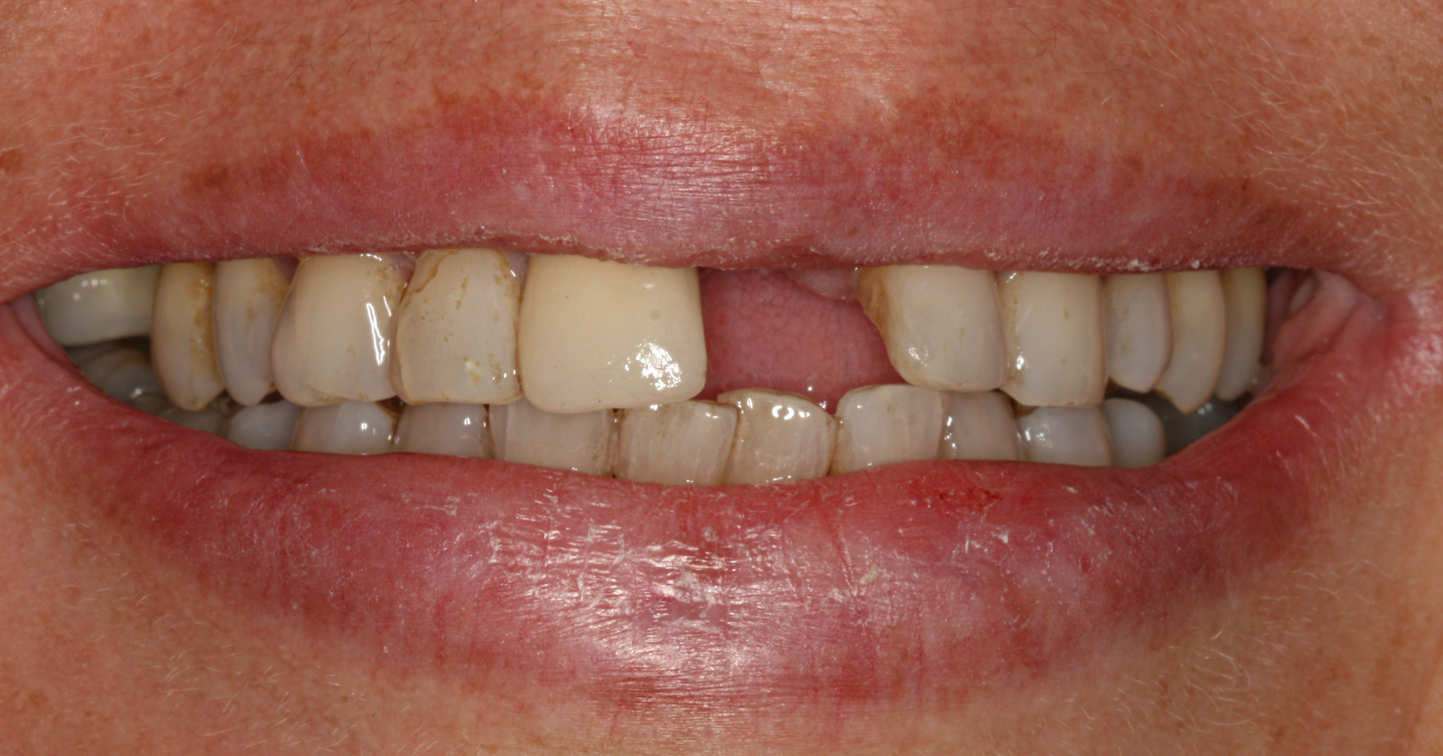 Teeth Supported Porcelain Bridges - Before