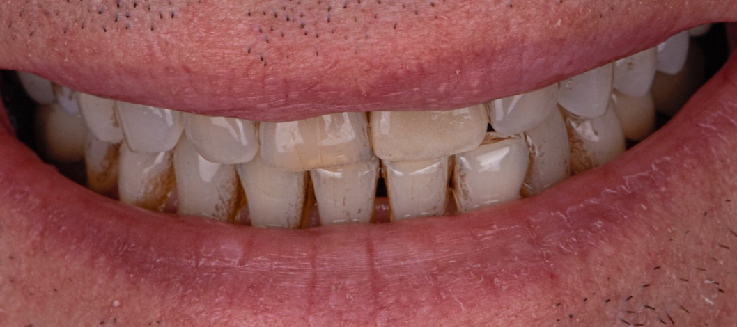 Teeth Whitening Porcelain Veneer Crown Cosmetic Bonding - Before