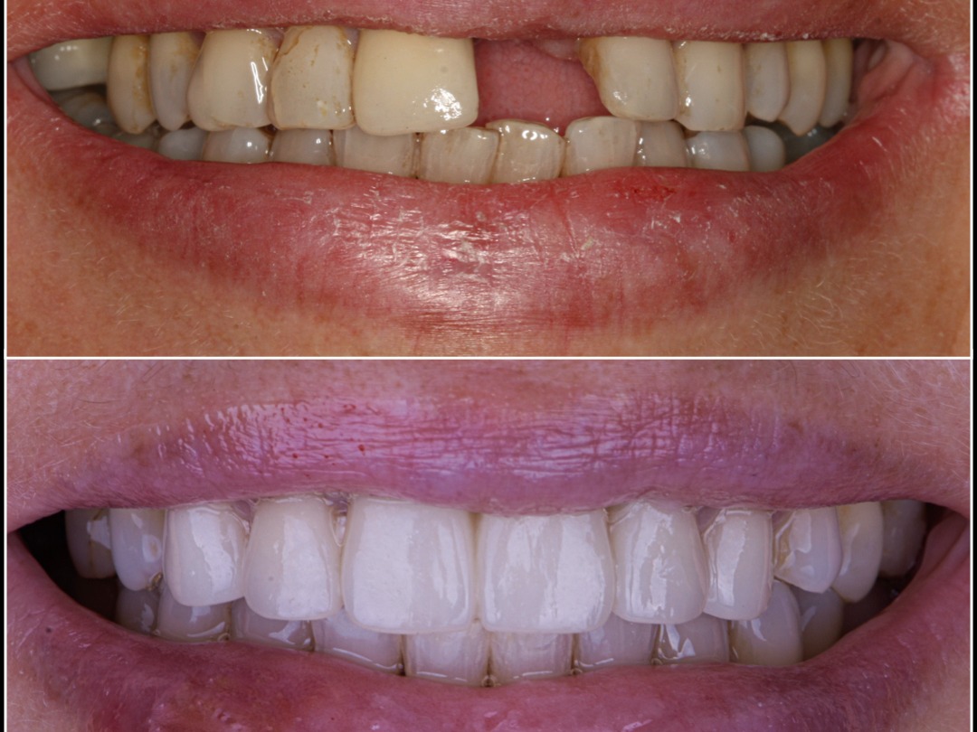 Bridges on Teeth