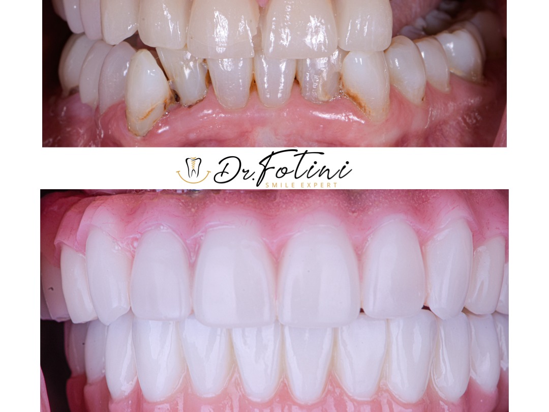 Implant Bridges