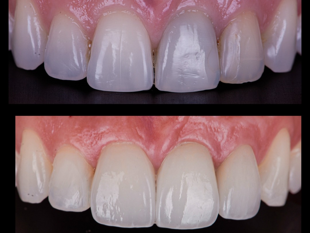 Smile Makeover