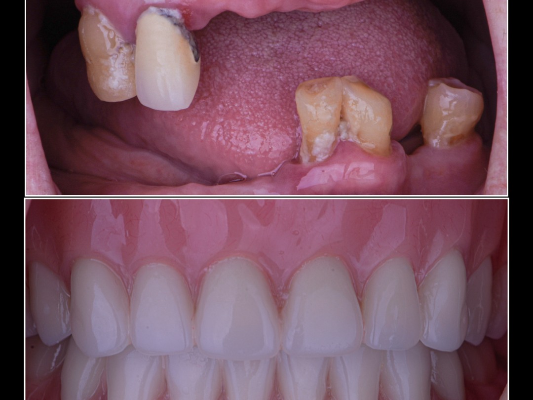 Immediate Dentures
