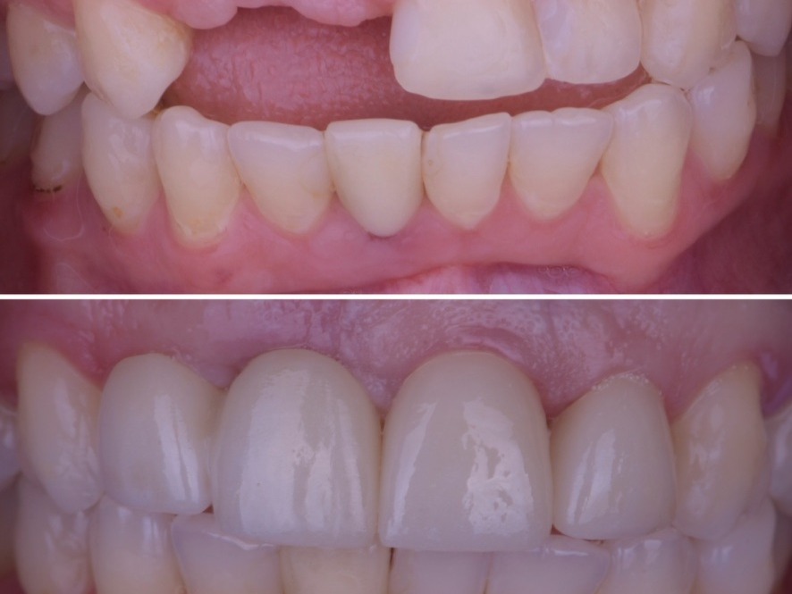 Implant Crowns