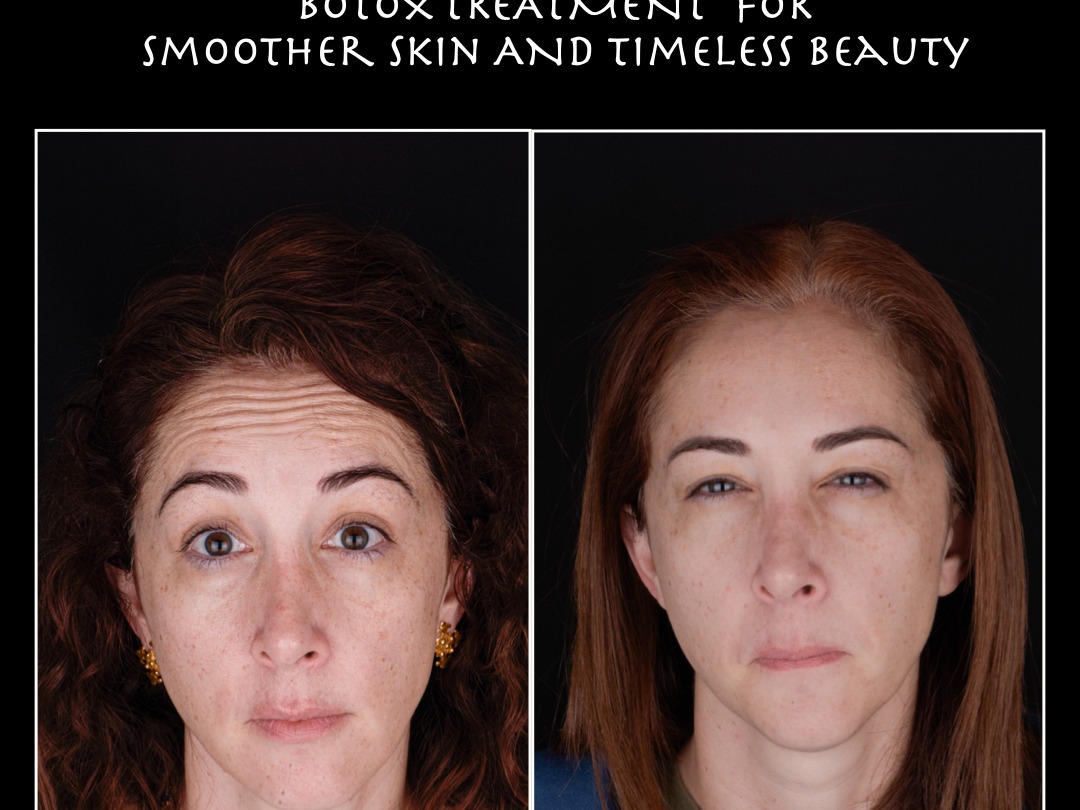Botox (therapeutic and cosmetic)